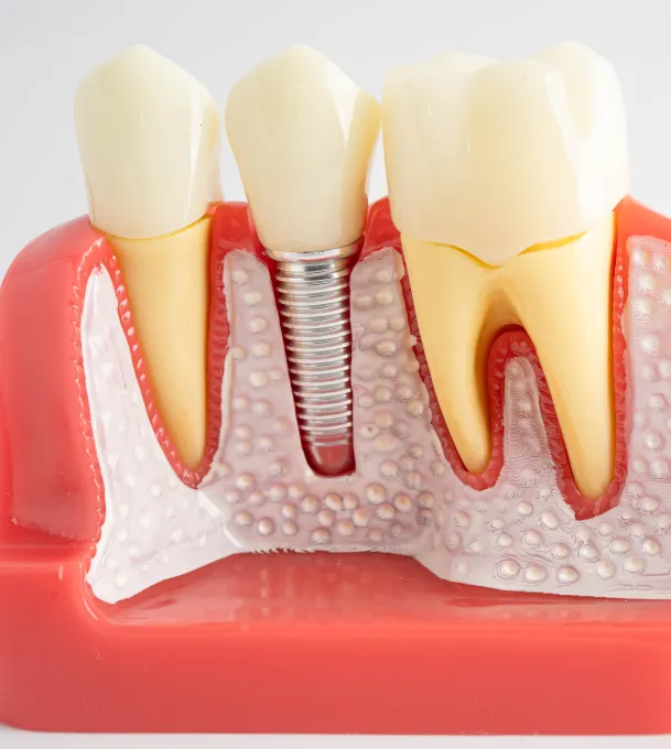 Dental Implants at Hatfield Cosmetic & Family Dentistry in Greer, South Carolina